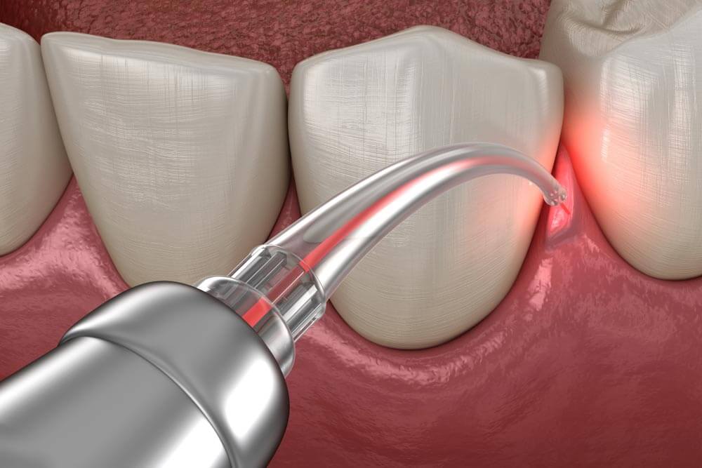 Gum correction surgery with laser