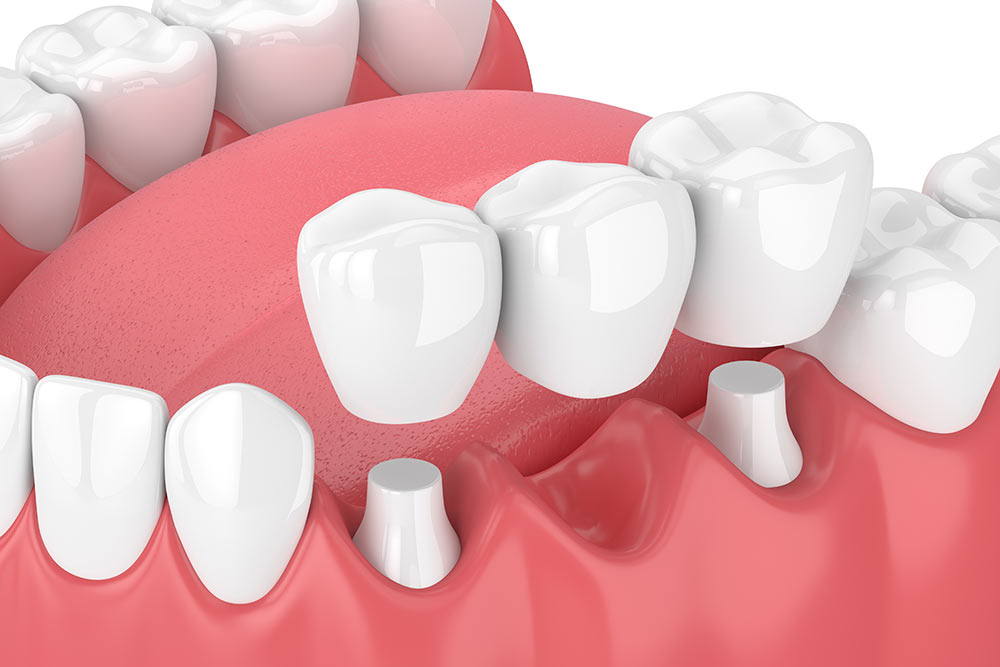 3d render of jaw with dental bridge