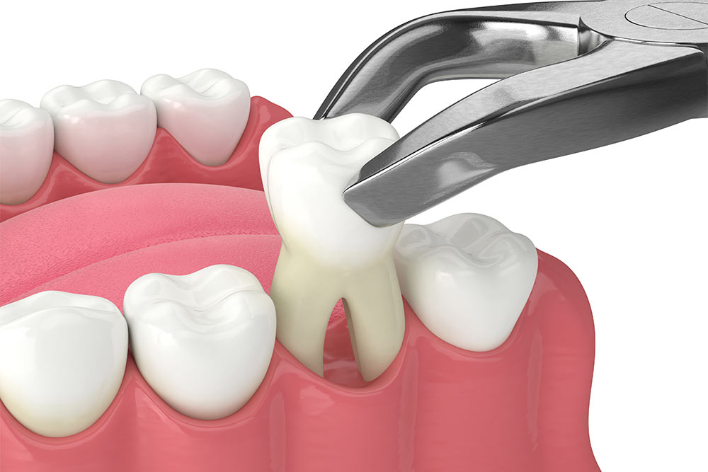 3d render of lower jaw with tooth extracted