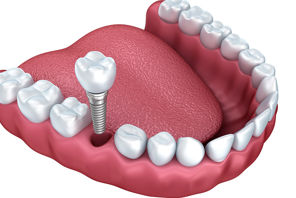 3d lower teeth and dental implant isolated