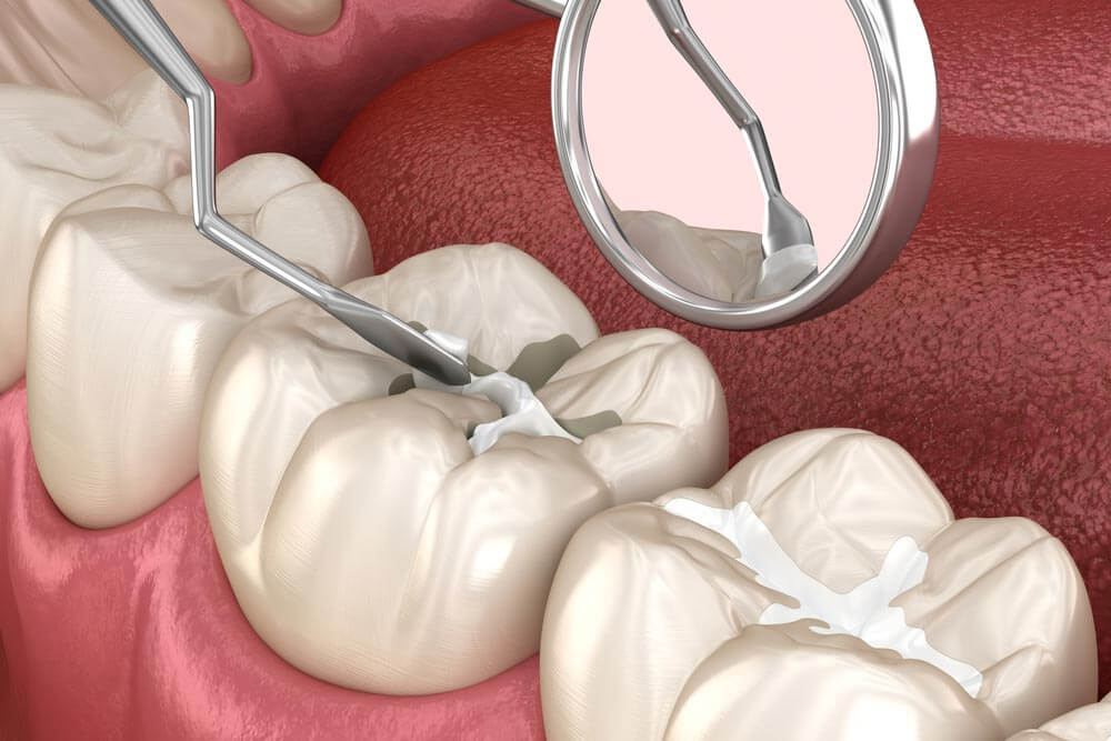 Molar tooth fissure restoration with filling