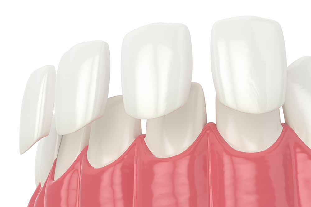 3d render of teeth with veneers over white