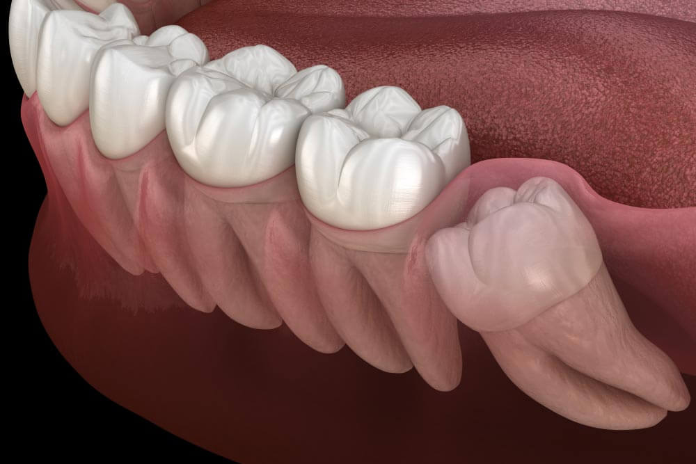 Wisdom tooth with impaction at molar tooth